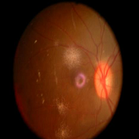 Ophthalmic disease model