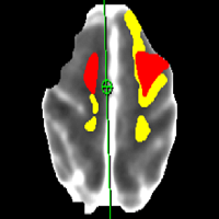  Ischemic Stroke Model